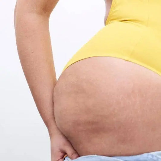 HOW TO GET RID OF CELLULITE FAST